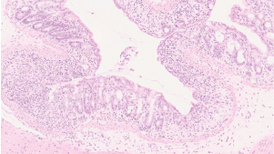 Inflamed colon that lost the capacity to undergo autophagy in the adipose tissue.