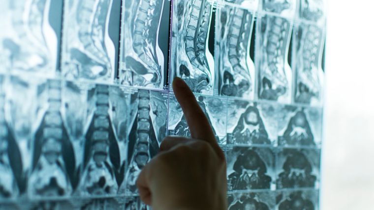 Hand pointing at an MRI scan of a spine