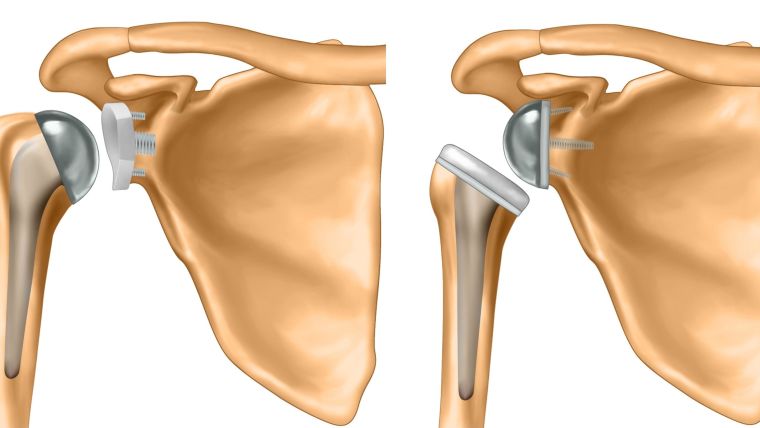Anatomical and reverse total shoulder replacements