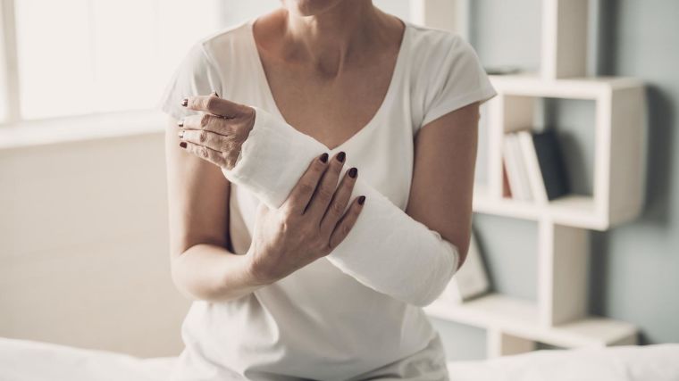 Woman with a broken wrist in a traditional plaster cast