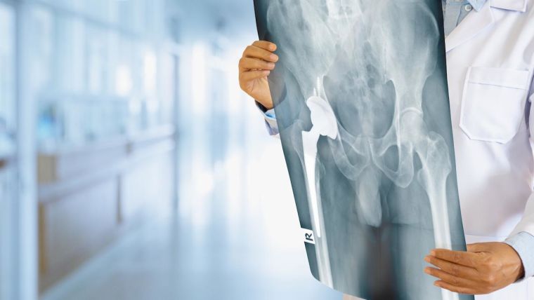Doctor looking at total hip replacement X-ray film with blurred hospital background