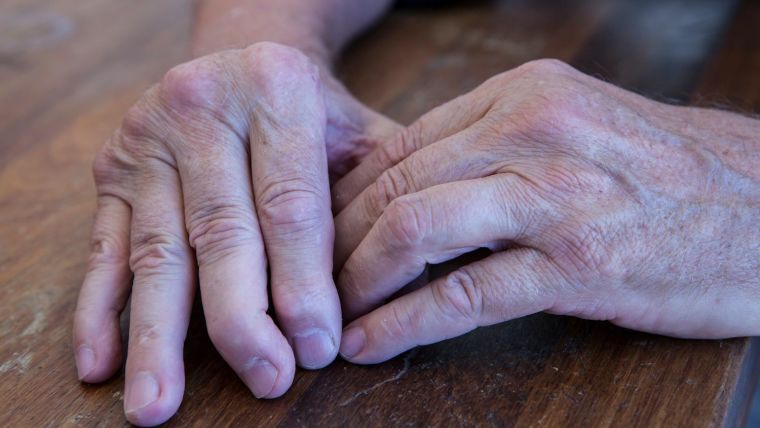 Hands of a person with psoriatic arthritis
