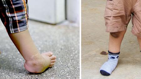 Clubfoot — Before and After