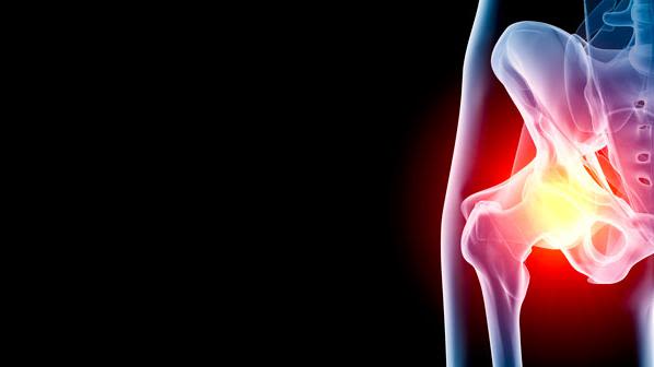 Our research focuses on hip osteoarthritis, from identifying its causes to developing new surgery techniques for the condition.